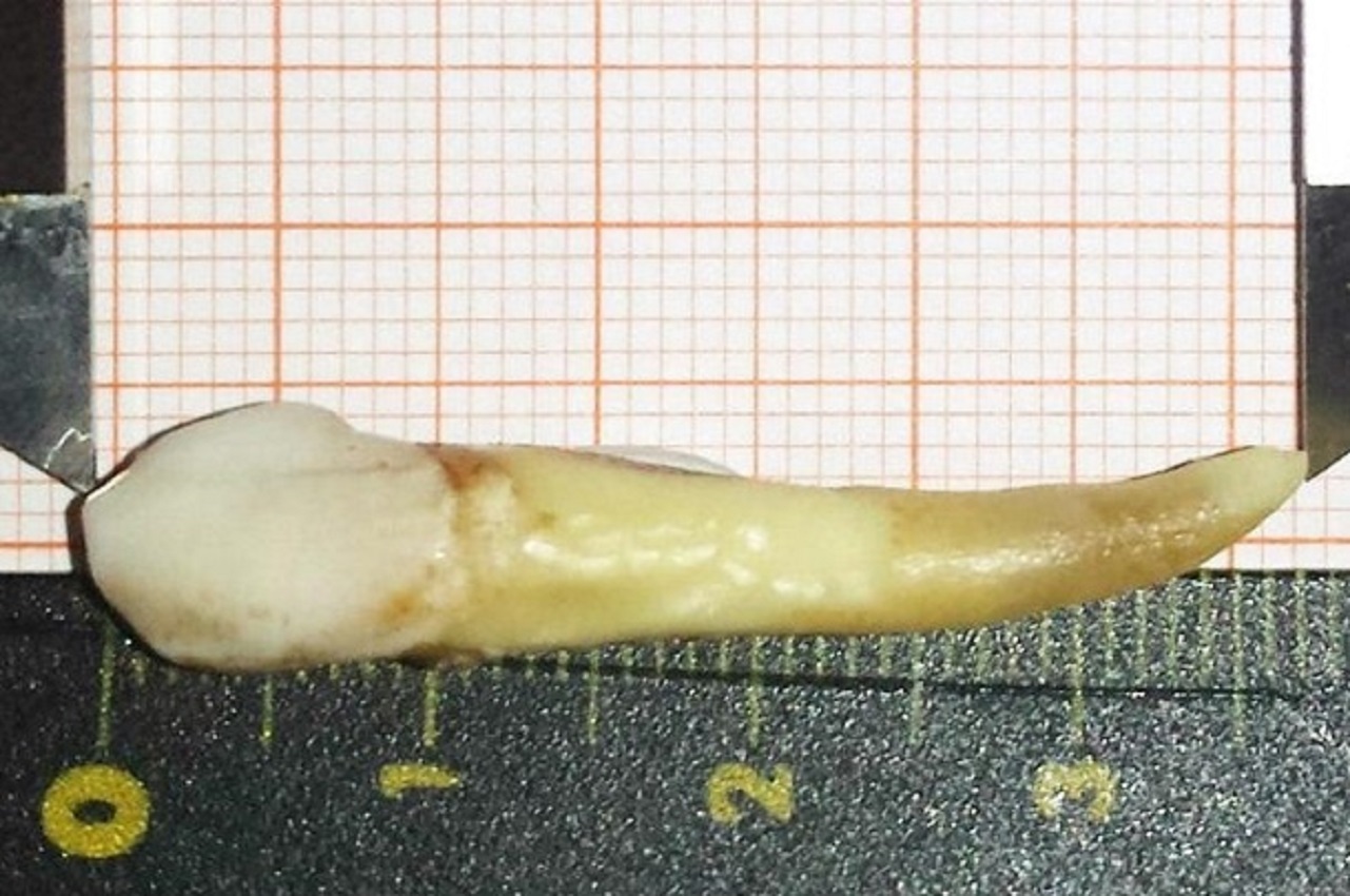 Пациенту удалили рекордный по размерам зуб (фото)