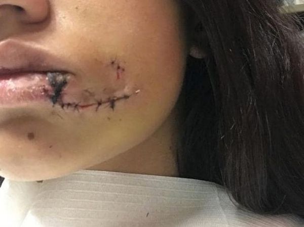 Собака разорвала девушке лицо во время фотосессии (фото)
